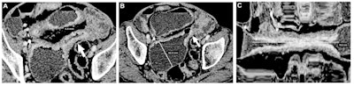 CT, MRI enterography show promise for assessing Crohn’s disease