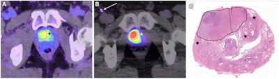 New theranostics delivery route tested for prostate cancer