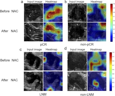 Ultrasound-based model performs well in predicting breast tumor status