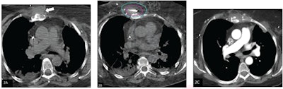 Cryoablation safe, effective in treating soft-tissue sarcoma
