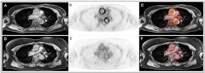 PET/MRI shows promise in patients with large vessel vasculitis