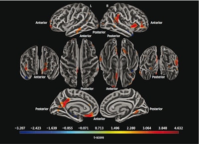 PET reveals brain pathology that may drive depression