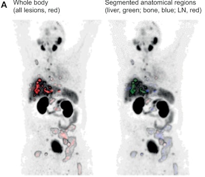 PET scans predict patient response to Pluvicto