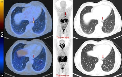 PET tracer performs well in prostate cancer trial