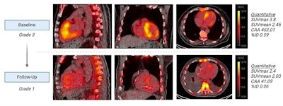 SPECT/CT visualizes heart’s response to tafamidis