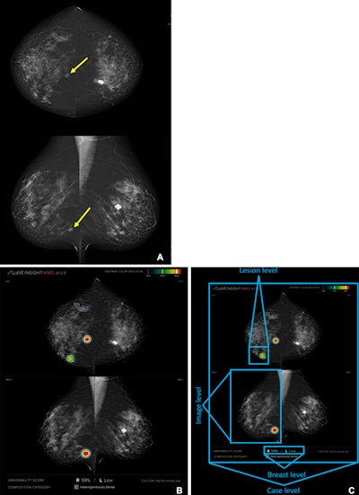 AI helps out with spotting, localizing interval breast cancers
