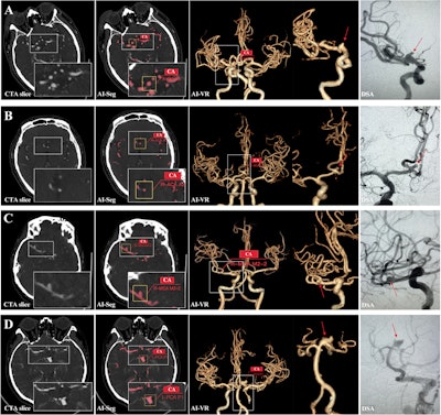 AI model can detect, segment cerebral aneurysms on CTA