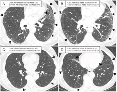 Machine learning used with CT imaging foretells lung abnormalities