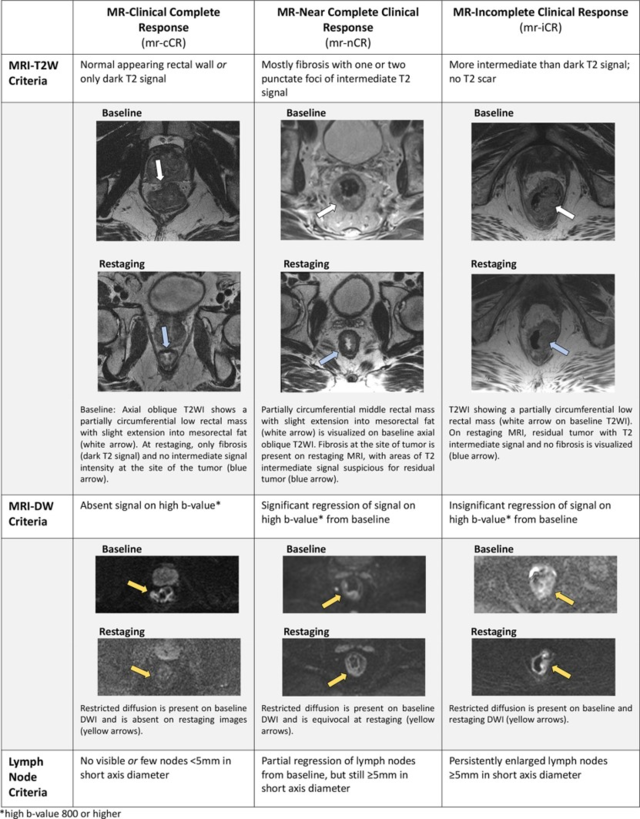 Restaging MRI in rectal cancer patients helps predict outcomes