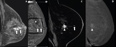 CEM-guided biopsy not a good substitute for breast MRI