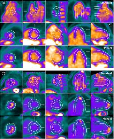 AI may help visualize cardiac sarcoidosis
