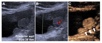 Researchers develop a CEUS bladder cancer scoring metric