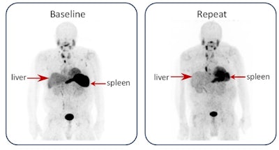 PET tracer reveals treatment responses in cardiac amyloidosis patients
