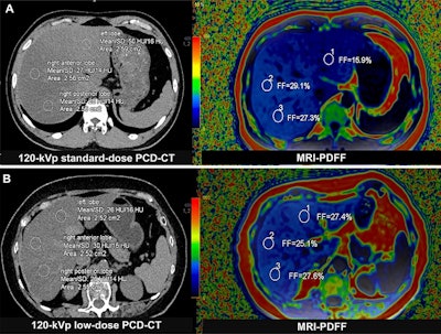 Photon-counting CT emerges as alternative for assessing fatty liver disease