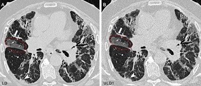 Photon-counting CT reduces radiation in lung transplant patients