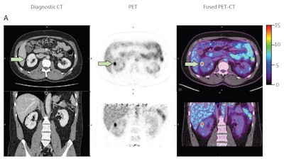 Radiotracer for kidney cancer performs well in phase III trial
