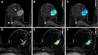 MRI model predicts treatment response in breast cancer patients