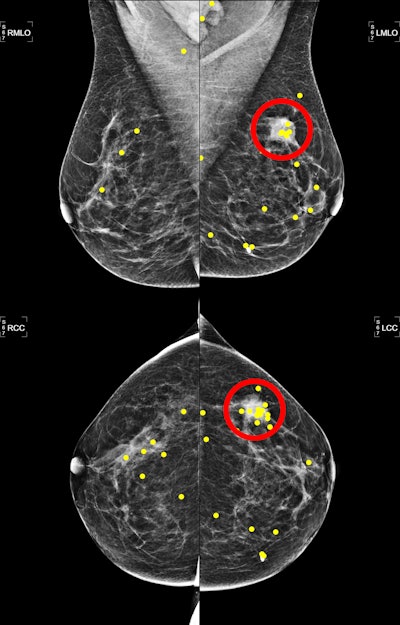 Mammogram reads improve when arranged from low to high breast density