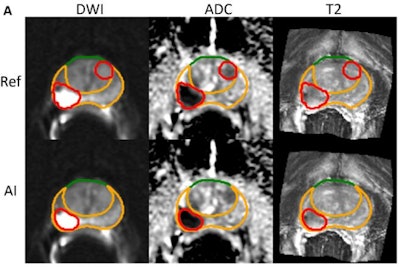 Volume of AI-segmented lesions predicts prostate cancer outcomes