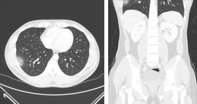 AuntMinnie 2020: COVID-19 can be seen on CT scans outside the chest