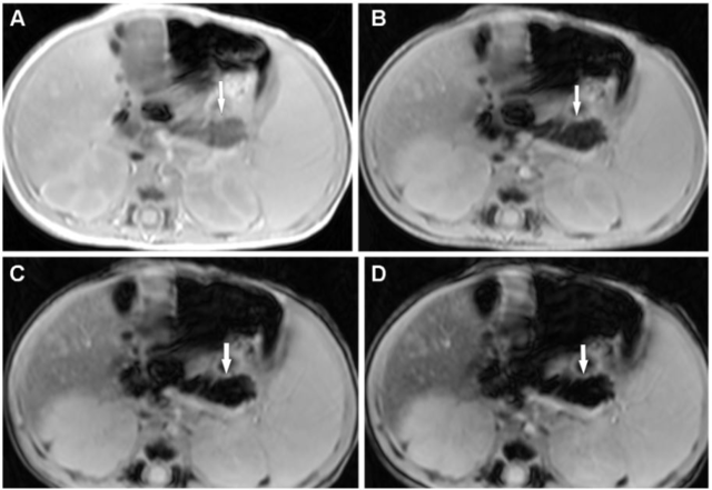 Choose wisely when it comes to neonatal liver imaging