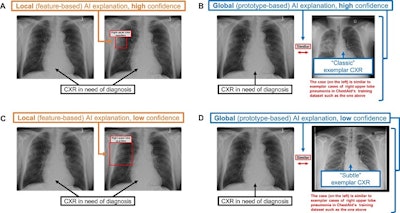 Radiologists prefer local vs. global AI advice
