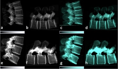 Dark-field x-ray detects bone changes related to osteoporosis