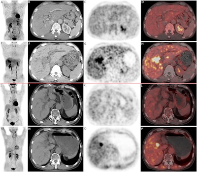 FAPI-PET/CT superior to FDG-PET/CT in assessing liver cancer