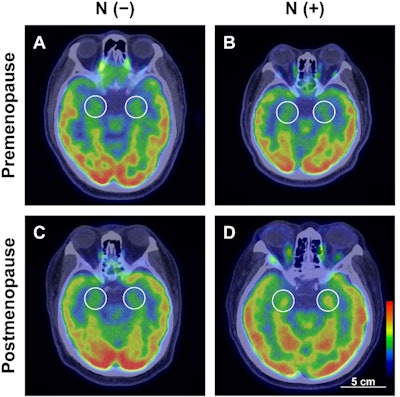PET links chronic stress to aggressive endometrial cancer