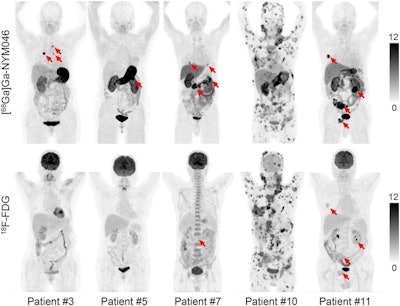 New PET tracer shows promise in patients with kidney cancer