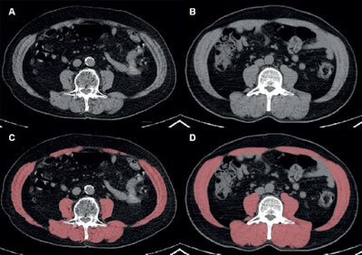 Does obesity improve NSCLC patients’ postsurgery survival?